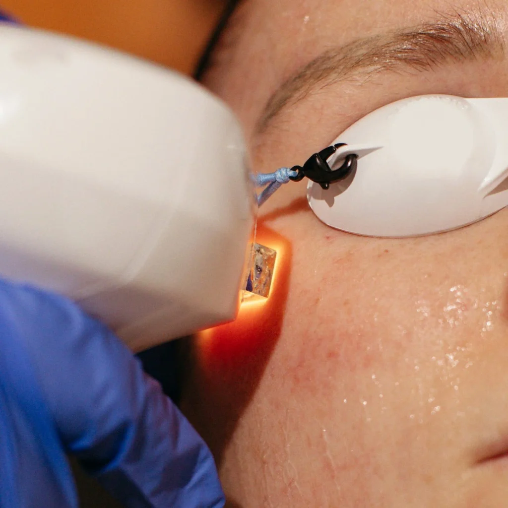Lumecca IPL treatment for post-summer pigmentation at La Peau Skin Lab in North Vancouver